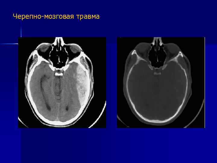 Черепно-мозговая травма 