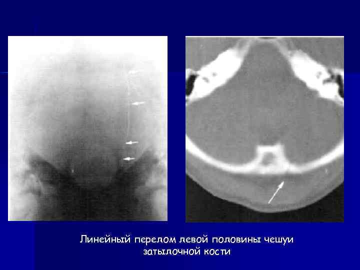 Линейная трещина. Линейный перелом чешуи затылочной кости.