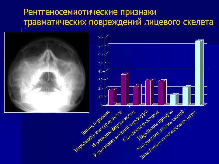 Рентгеносемиотические признаки травматических повреждений лицевого скелета 71, 4% 34, 3% 27, 6% 17, 1%