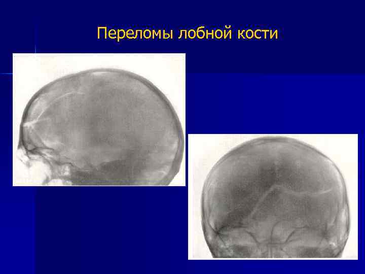 Линейная трещина. Вмятый перелом лобной кости.