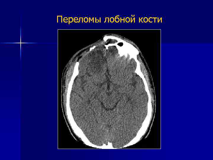 Переломы лобной кости 