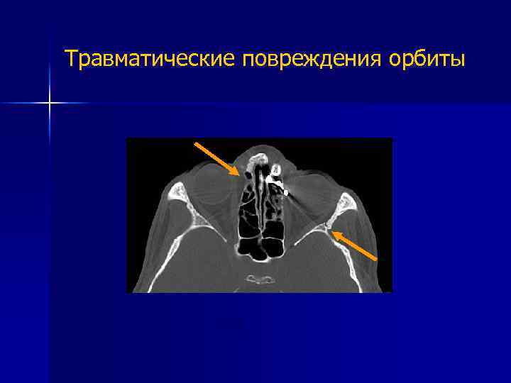 Травматические повреждения орбиты КТ 