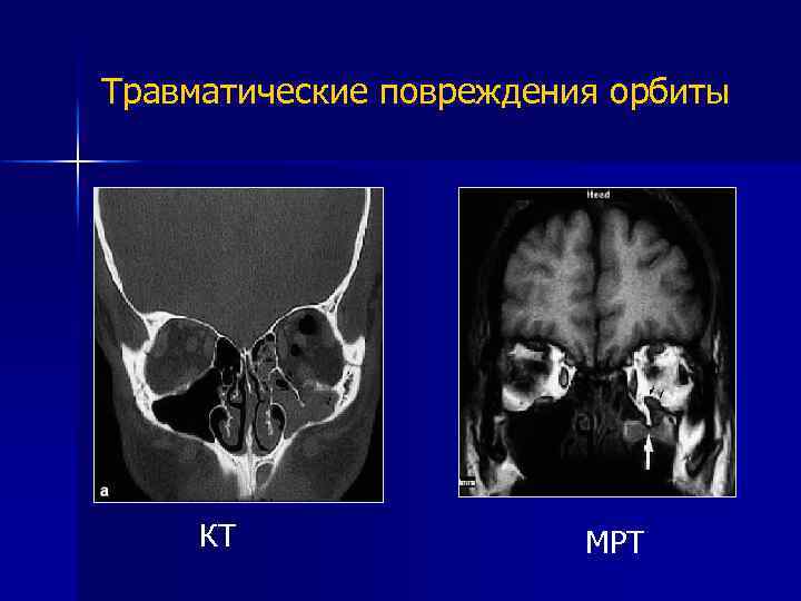 Травматические повреждения головного мозга