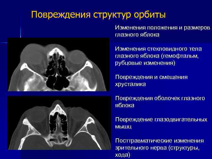 Перелом медиальной стенки орбиты