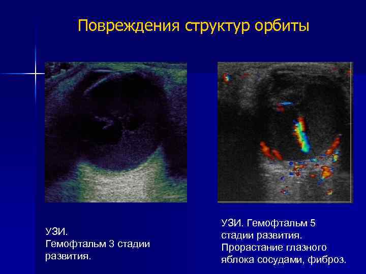 Повреждения структур орбиты УЗИ. Гемофтальм 3 стадии развития. УЗИ. Гемофтальм 5 стадии развития. Прорастание