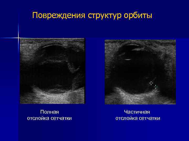 Повреждения структур орбиты Полная отслойка сетчатки Частичная отслойка сетчатки 