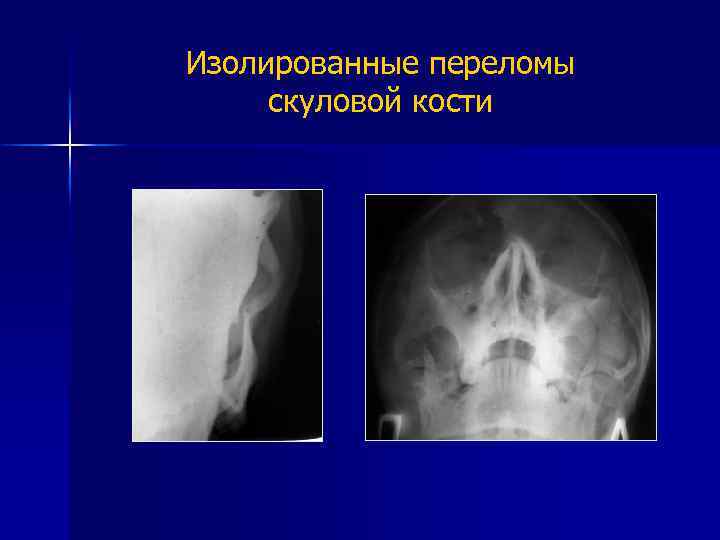 Изолированные переломы скуловой кости 