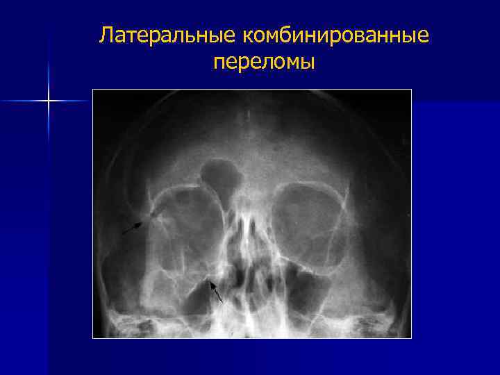 Латеральные комбинированные переломы 