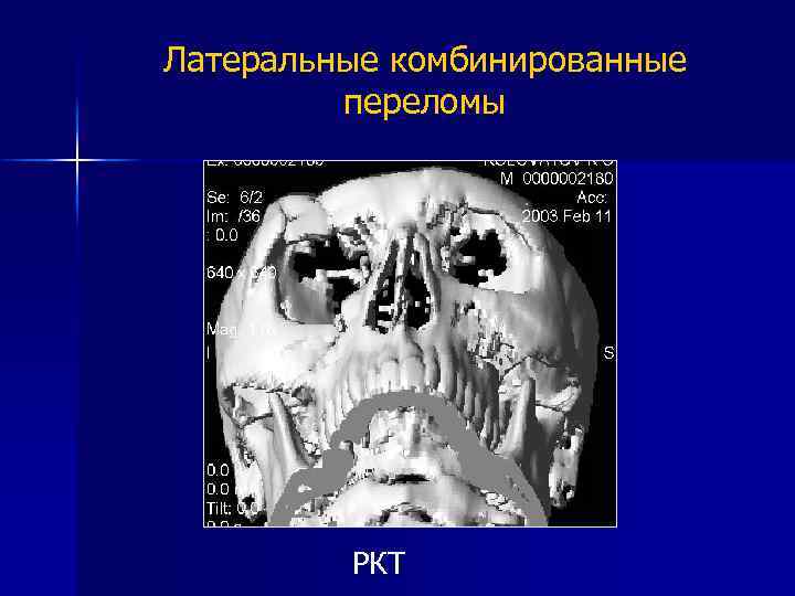 Латеральные комбинированные переломы РКТ 