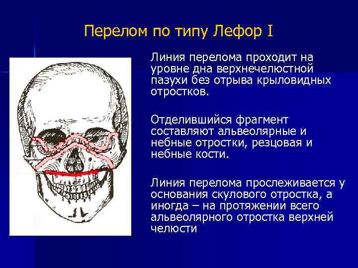 Нижний тип. Перелом верхней челюсти по Лефору. Типы переломов по Лефору.