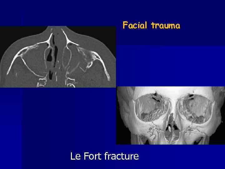 Facial trauma Le Fort fracture 