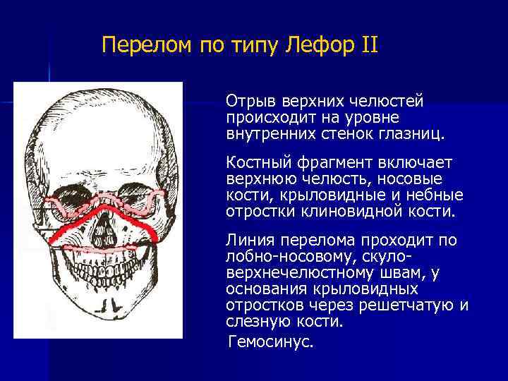 Перелом по типу Лефор II Отрыв верхних челюстей происходит на уровне внутренних стенок глазниц.