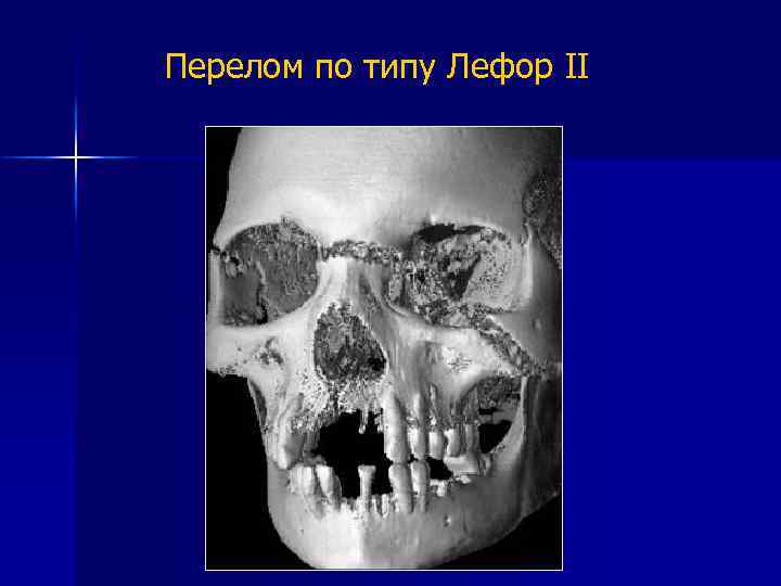 Перелом по типу Лефор II СКТ 3 D 