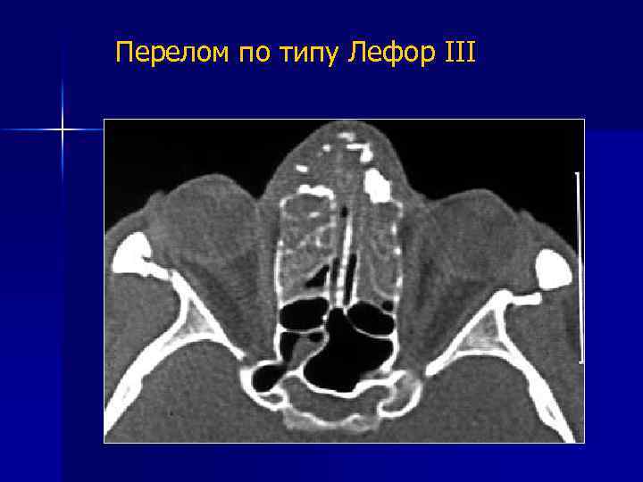 Перелом по типу Лефор III 