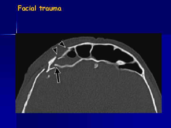 Facial trauma 