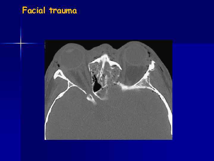 Facial trauma 