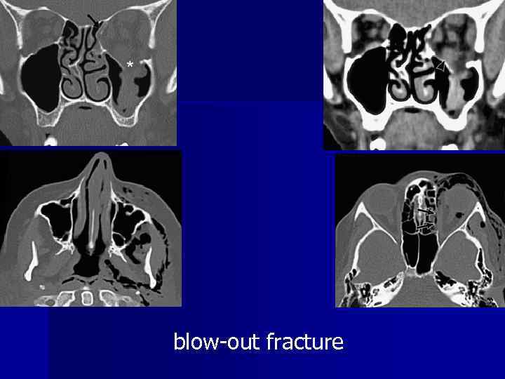 Facial trauma blow-out fracture 