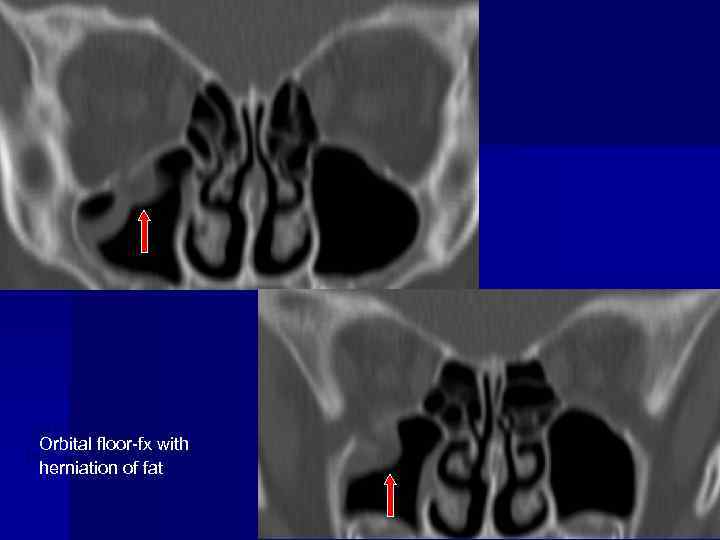 Orbital floor-fx with herniation of fat 