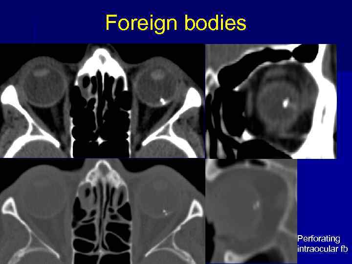 Foreign bodies Perforating intraocular fb 