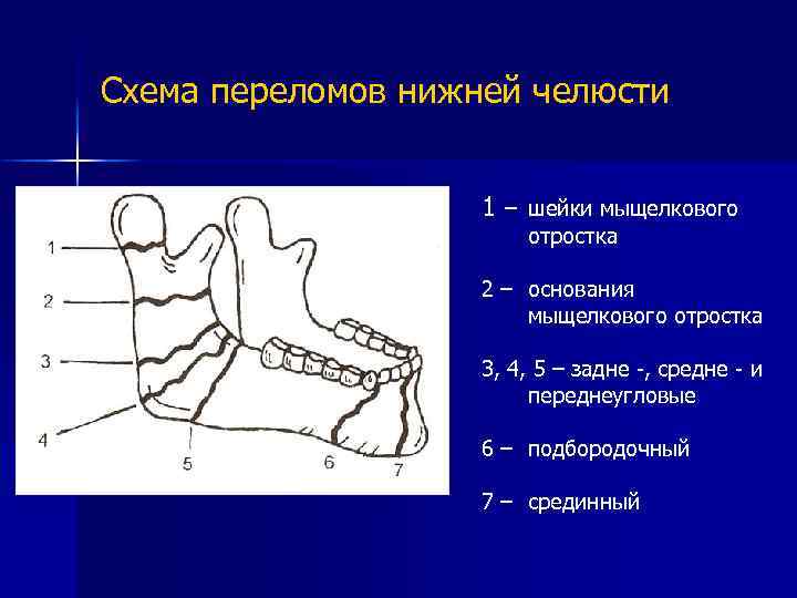 Перелом мыщелкового отростка нижней челюсти. Классификация переломов мыщелкового отростка нижней челюсти. Суставной отросток нижней челюсти перелом. Виды перелома мыщелкового отростка нижней челюсти.