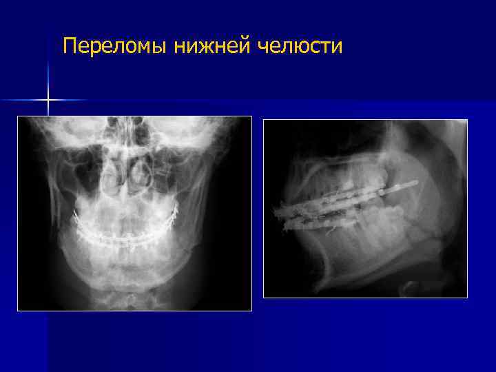 Переломы нижней челюсти 