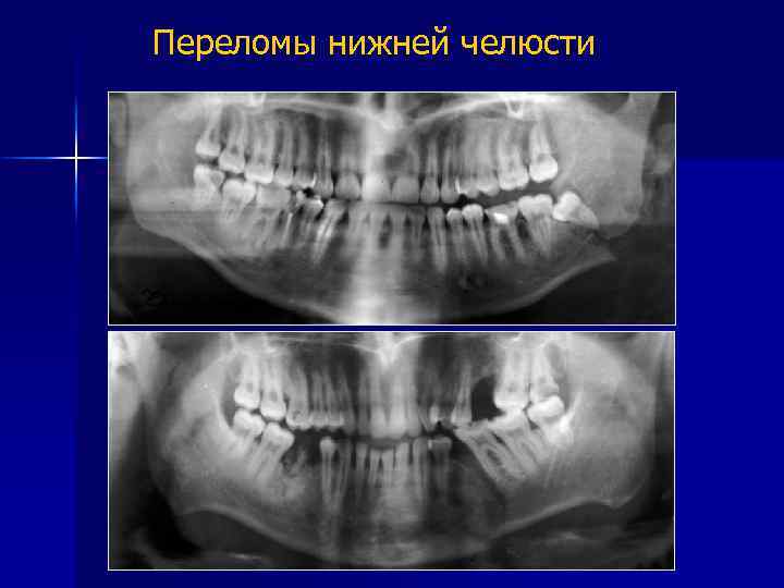 Переломы нижней челюсти 