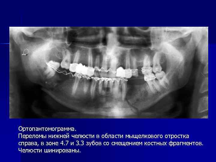 Ортопантомограмма. Переломы нижней челюсти в области мыщелкового отростка справа, в зоне 4. 7 и