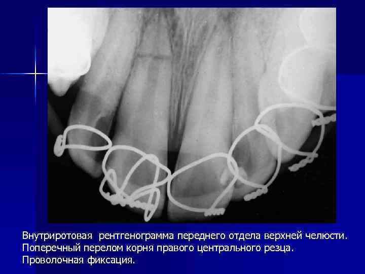 Внутриротовая рентгенограмма переднего отдела верхней челюсти. Поперечный перелом корня правого центрального резца. Проволочная фиксация.