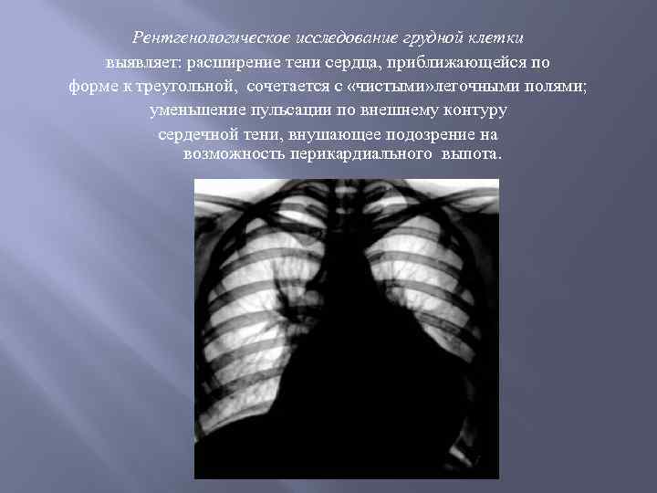 Рентгенологическое исследование грудной клетки выявляет: расширение тени сердца, приближающейся по форме к треугольной, сочетается