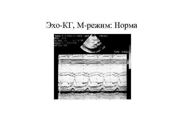 Эхо-КГ, М-режим: Норма 