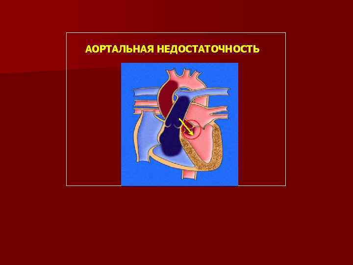 АОРТАЛЬНАЯ НЕДОСТАТОЧНОСТЬ 
