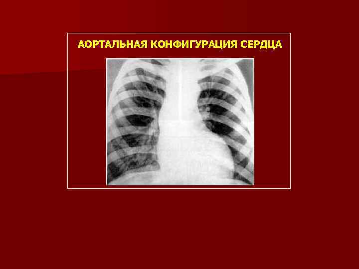 АОРТАЛЬНАЯ КОНФИГУРАЦИЯ СЕРДЦА 