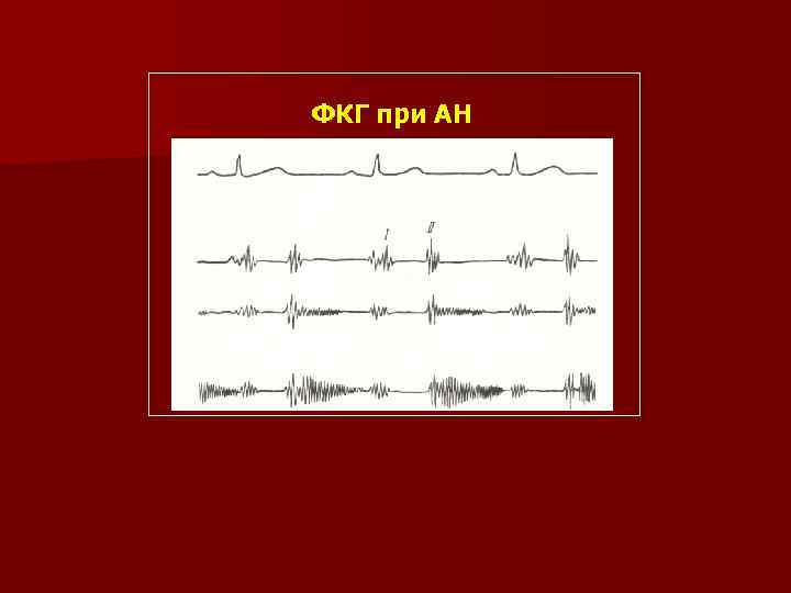 ФКГ при АН 