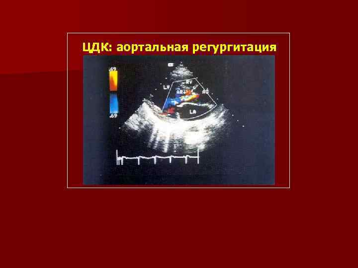 ЦДК: аортальная регургитация 