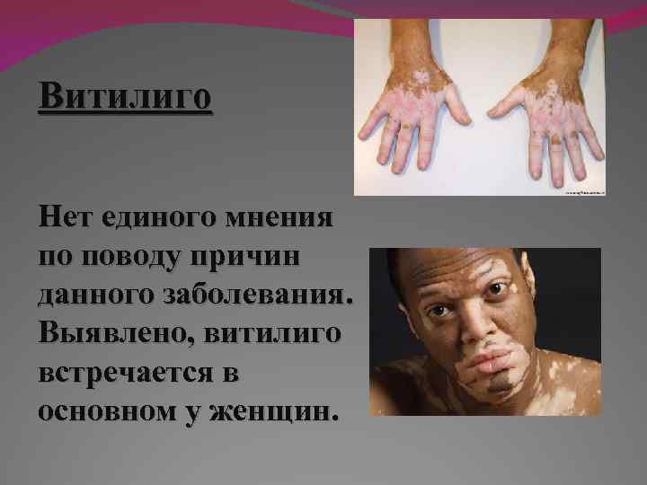 Витилиго Нет единого мнения по поводу причин данного заболевания. Выявлено, витилиго встречается в основном