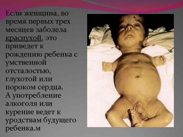 Если женщина, во время первых трех месяцев заболела краснухой, это приведет к рождению ребенка