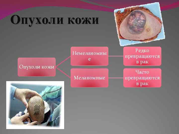 Опухоли кожи Немеланомны е Редко превращаются в рак Меланомные Часто превращаются в рак Опухоли