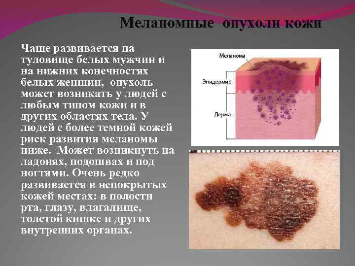 Меланомные опухоли кожи Чаще развивается на туловище белых мужчин и на нижних конечностях белых