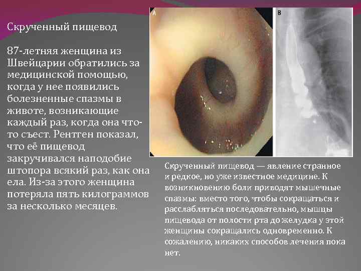 Скрученный пищевод 87 -летняя женщина из Швейцарии обратились за медицинской помощью, когда у нее