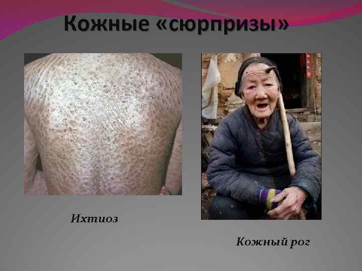 Кожные «сюрпризы» Ихтиоз Кожный рог 