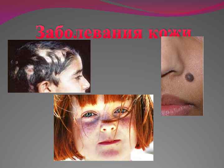 Заболевания кожи 