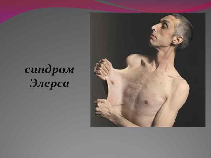 синдром Элерса 