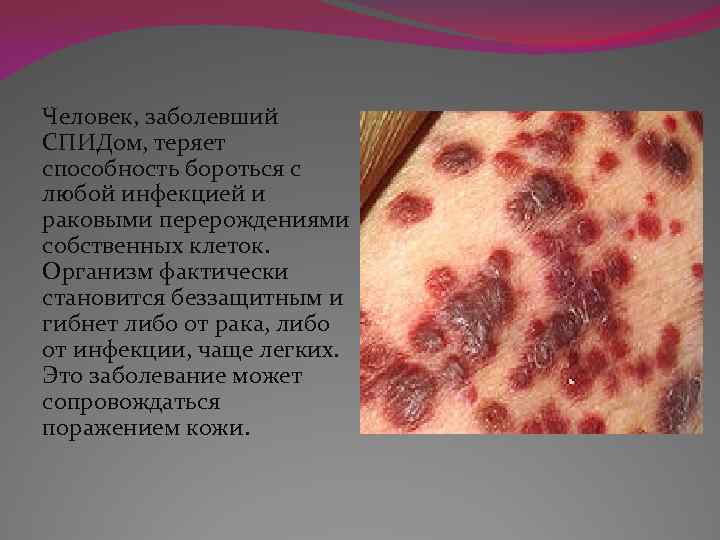Человек, заболевший СПИДом, теряет способность бороться с любой инфекцией и раковыми перерождениями собственных клеток.