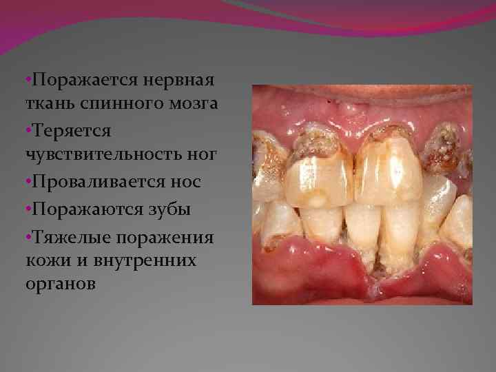  • Поражается нервная ткань спинного мозга • Теряется чувствительность ног • Проваливается нос