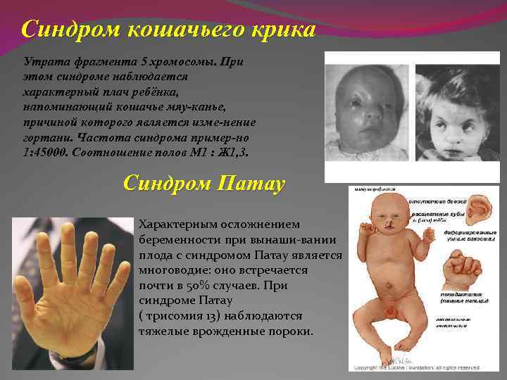 Синдром кошачьего крика Утрата фрагмента 5 хромосомы. При этом синдроме наблюдается характерный плач ребёнка,