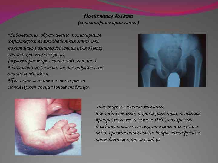 Полигенные болезни (мультифакториальные) • Заболевания обусловлены полимерным характером взаимодействия генов или сочетанием взаимодействия нескольких