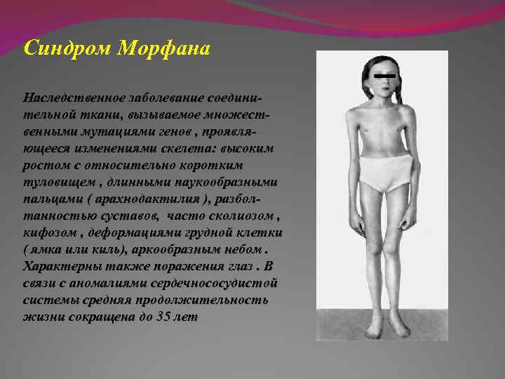 Синдром Морфана Наследственное заболевание соединительной ткани, вызываемое множественными мутациями генов , проявляющееся изменениями скелета: