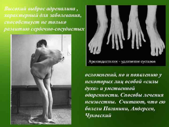 Высокий выброс адреналина , характерный для заболевания, способствует не только развитию сердечно-сосудистых Арахнодактилия –