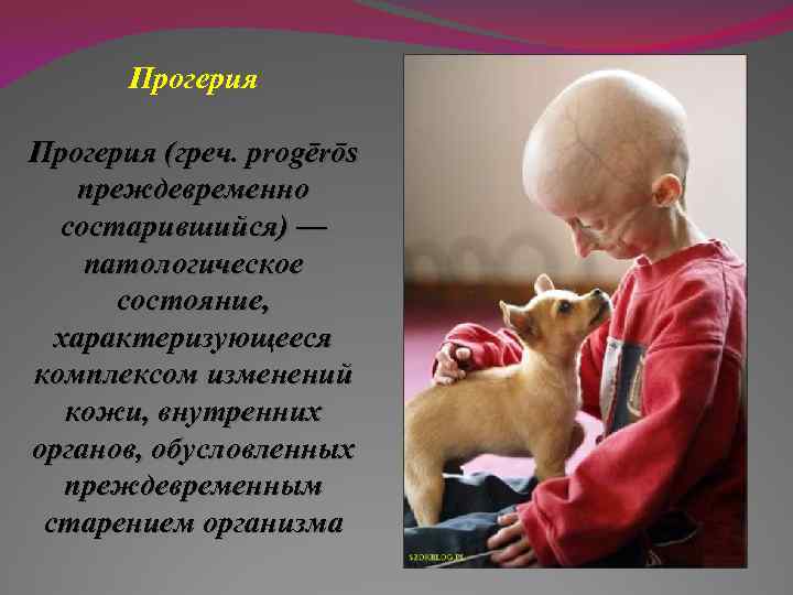 Прогерия (греч. progērōs преждевременно состарившийся) — патологическое состояние, характеризующееся комплексом изменений кожи, внутренних органов,
