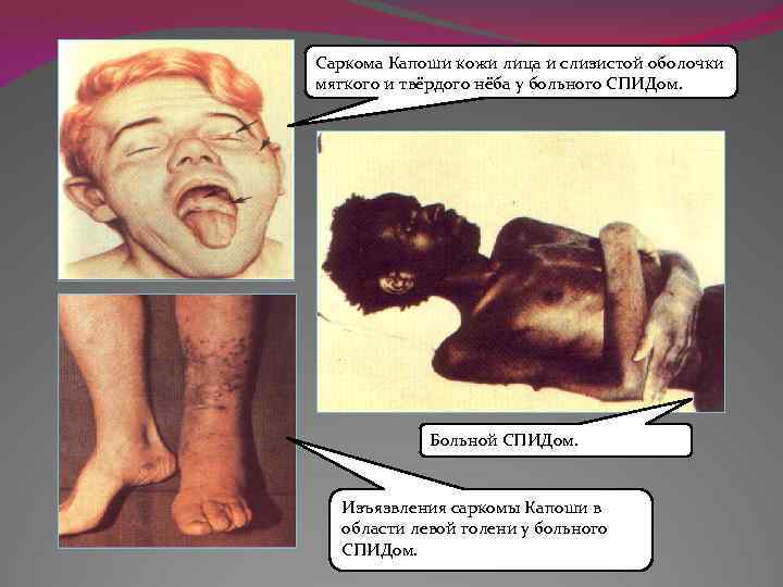 Саркома Капоши кожи лица и слизистой оболочки мягкого и твёрдого нёба у больного СПИДом.